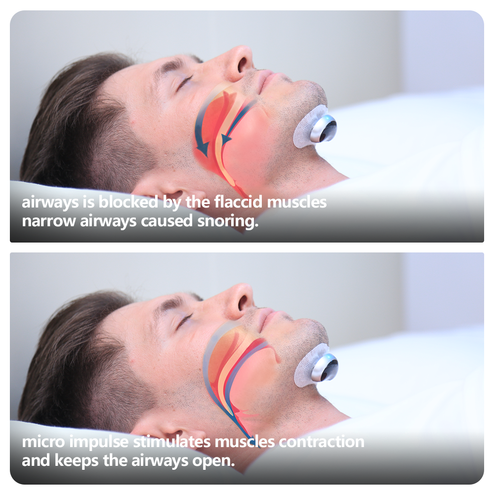 Silentia Pro  Dispositif Anti-Ronflement Intelligent EMS